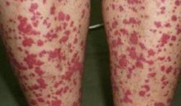 性紫癜可以吃葫芦瓜吗,葫芦瓜的适宜性分析